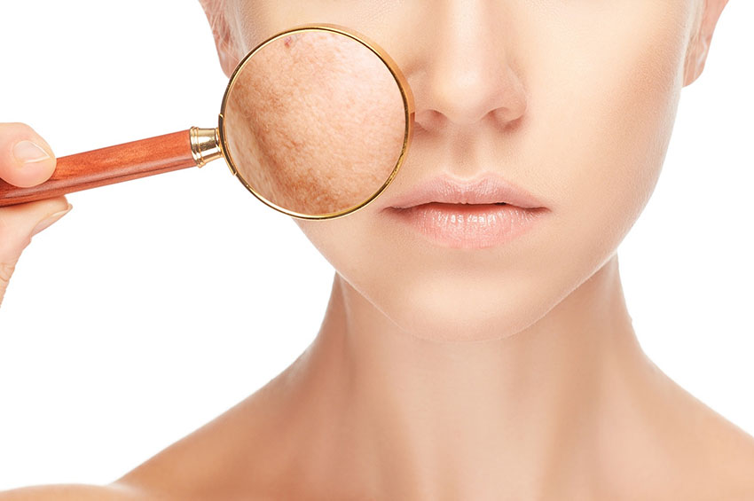 Melasma Entenda As Causas E Como Prevenir Essas Manchas Na Pele