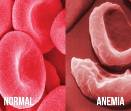 Anemia falciforme: a doença do sangue que não tem cura