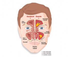 Minimize a sensação de obstrução e coriza com higienização nasal