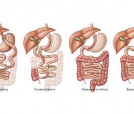 Conheça os benefícios da cirurgia bariátrica que vão além da perda de peso