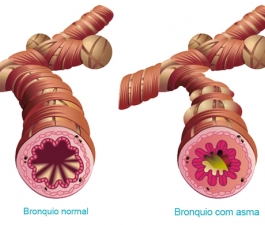 Como é feito o diagnóstico da asma