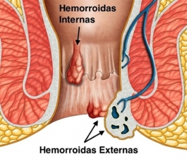 Fissura Anal e Hemorroida: Mudança de hábitos alimentares e de higiene ajudam no tratamento