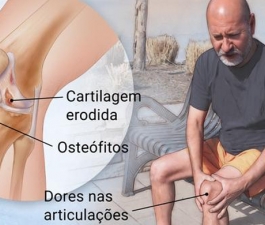 Ortopedista do HCor dá dicas para amenizar as dores da artrose