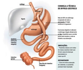 Cirurgia bariátrica: cinco coisas que todo paciente que quer emagrecer precisa saber