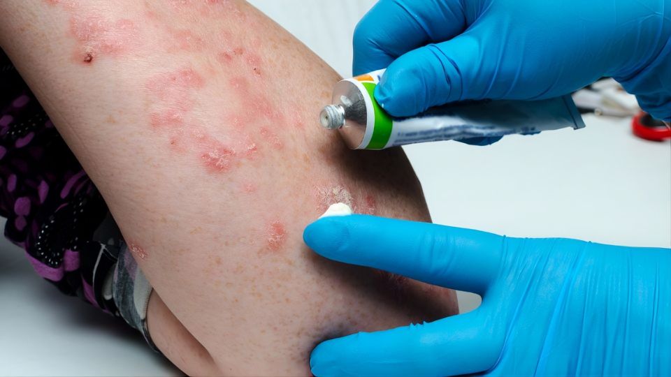 Psoríase no inverno: por que os sintomas costumam piorar e quais cuidados ajudam a controlar as crises
