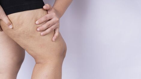 Lipedema: quais são os melhores alimentos para reduzir dor e inchaço